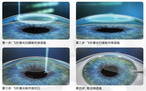 屈光矯視,希瑪瑞視眼科,上海眼科醫(yī)院