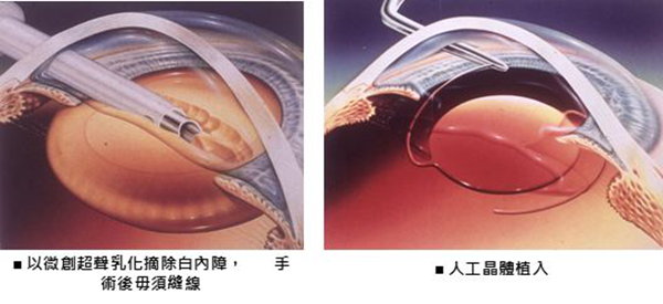 眼表眼角膜,?，斎鹨曆劭?上海眼科醫(yī)院