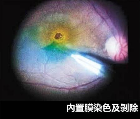 玻璃體視網(wǎng)膜,?，斎鹨曆劭?上海眼科醫(yī)院