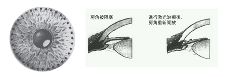 青光眼,?，斎鹨曆劭?上海眼科醫(yī)院