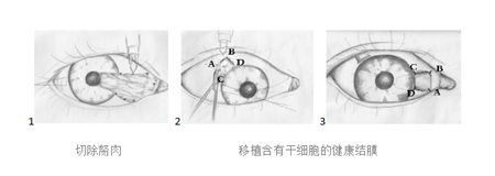 眼表眼角膜,?，斎鹨曆劭?上海眼科醫(yī)院