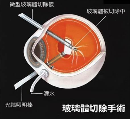 玻璃體視網(wǎng)膜,?，斎鹨曆劭?上海眼科醫(yī)院