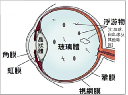 玻璃體視網(wǎng)膜,?，斎鹨曆劭?上海眼科醫(yī)院