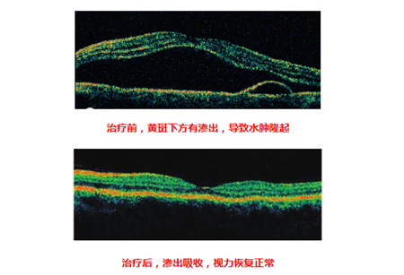 玻璃體視網(wǎng)膜,?，斎鹨曆劭?上海眼科醫(yī)院