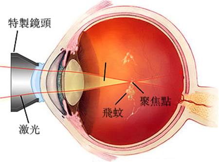 玻璃體視網(wǎng)膜,?，斎鹨曆劭?上海眼科醫(yī)院