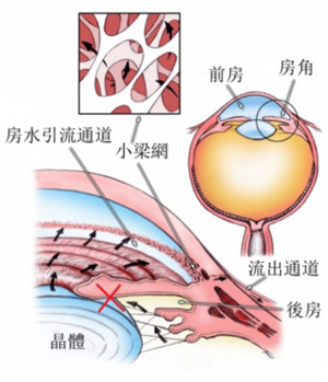 白內(nèi)障,希瑪瑞視眼科,上海眼科醫(yī)院