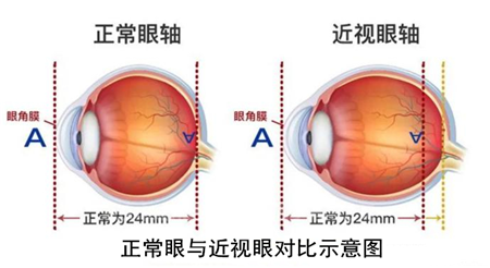 屈光矯視,?，斎鹨曆劭?上海眼科醫(yī)院