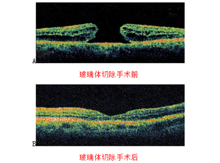 玻璃體視網(wǎng)膜,?，斎鹨曆劭?上海眼科醫(yī)院