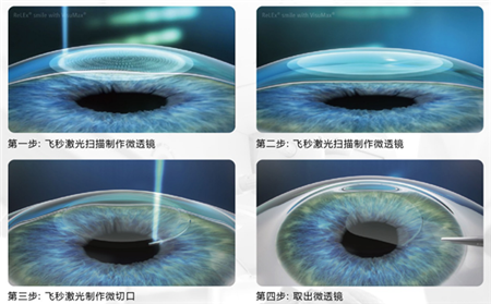 屈光矯視,?，斎鹨曆劭?上海眼科醫(yī)院