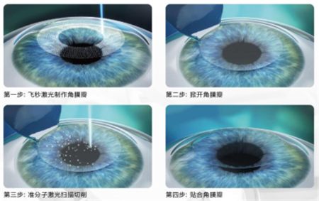 屈光矯視,?，斎鹨曆劭?上海眼科醫(yī)院