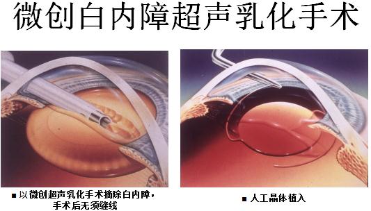白內(nèi)障,?，斎鹨曆劭?上海眼科醫(yī)院