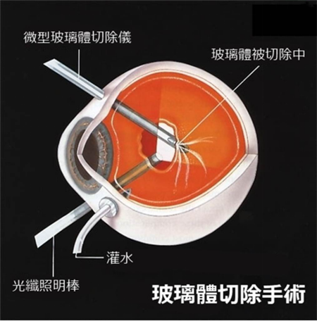 玻璃體視網(wǎng)膜,?，斎鹨曆劭?上海眼科醫(yī)院