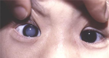 白內(nèi)障,希瑪瑞視眼科,上海眼科醫(yī)院
