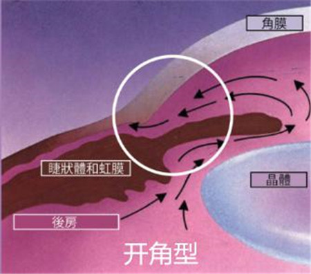青光眼,?，斎鹨曆劭?上海眼科醫(yī)院
