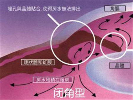 青光眼,?，斎鹨曆劭?上海眼科醫(yī)院
