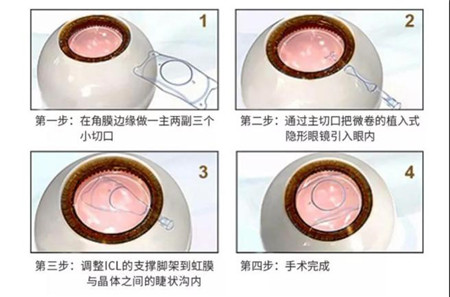 屈光矯視,?，斎鹨曆劭?上海眼科醫(yī)院