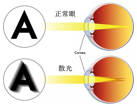 屈光矯視,?，斎鹨曆劭?上海眼科醫(yī)院