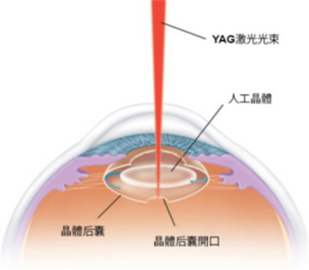 白內障,希瑪瑞視眼科,上海眼科醫(yī)院
