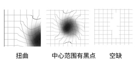 玻璃體視網(wǎng)膜,希瑪瑞視眼科,上海眼科醫(yī)院
