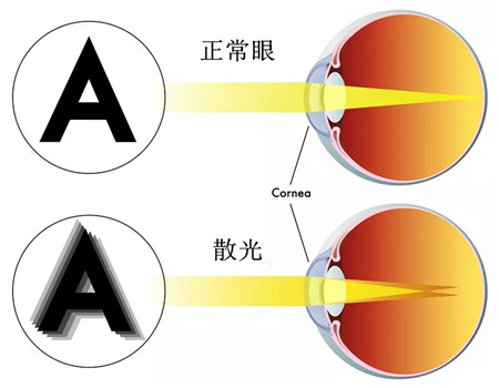 屈光矯視,?，斎鹨曆劭?上海眼科醫(yī)院