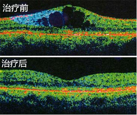 玻璃體視網(wǎng)膜,?，斎鹨曆劭?上海眼科醫(yī)院
