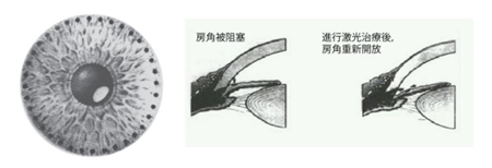 青光眼,希瑪瑞視眼科,上海眼科醫(yī)院