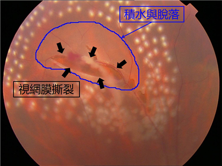 玻璃體視網(wǎng)膜,?，斎鹨曆劭?上海眼科醫(yī)院