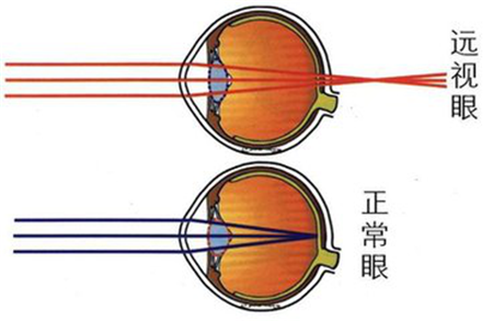 小兒眼病,?，斎鹨曆劭?上海眼科醫(yī)院