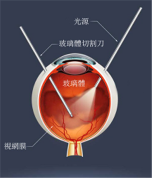 玻璃體視網(wǎng)膜,希瑪瑞視眼科,上海眼科醫(yī)院