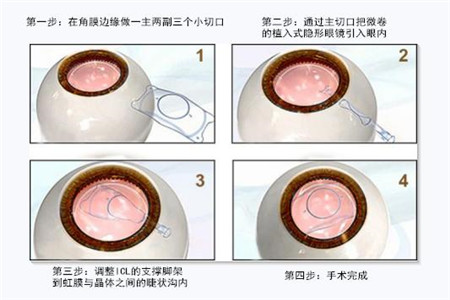 屈光矯視,?，斎鹨曆劭?上海眼科醫(yī)院
