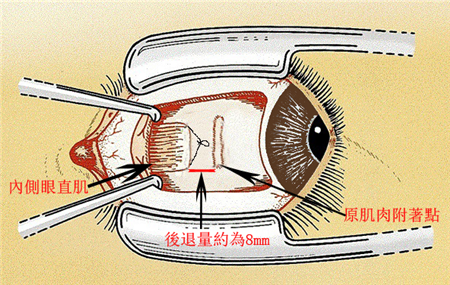 小兒眼病,?，斎鹨曆劭?上海眼科醫(yī)院