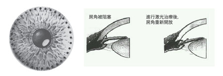 青光眼,?，斎鹨曆劭?上海眼科醫(yī)院