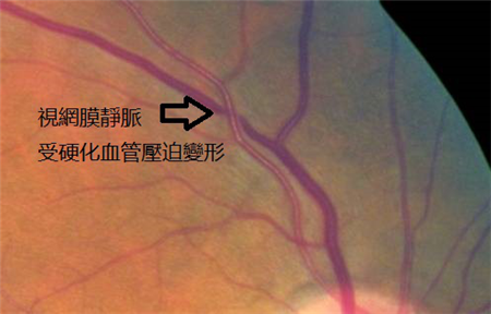 玻璃體視網(wǎng)膜,?，斎鹨曆劭?上海眼科醫(yī)院