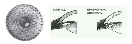 青光眼,?，斎鹨曆劭?上海眼科醫(yī)院
