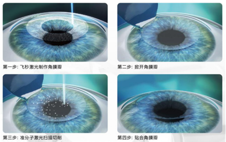 屈光矯視,?，斎鹨曆劭?上海眼科醫(yī)院