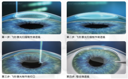 屈光矯視,?，斎鹨曆劭?上海眼科醫(yī)院