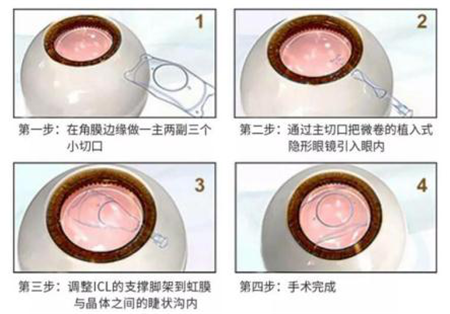 屈光矯視,?，斎鹨曆劭?上海眼科醫(yī)院