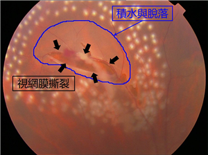 玻璃體視網(wǎng)膜,?，斎鹨曆劭?上海眼科醫(yī)院