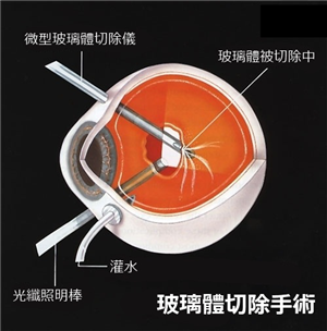 玻璃體視網(wǎng)膜,希瑪瑞視眼科,上海眼科醫(yī)院