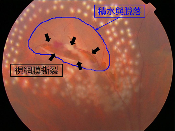 玻璃體視網(wǎng)膜,?，斎鹨曆劭?上海眼科醫(yī)院