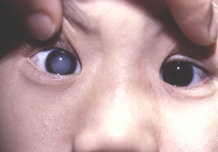 小兒眼病,?，斎鹨曆劭?上海眼科醫(yī)院