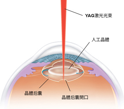 玻璃體視網(wǎng)膜,?，斎鹨曆劭?上海眼科醫(yī)院