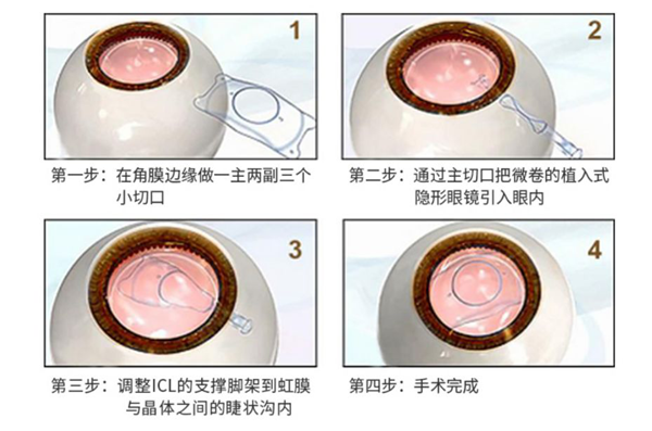 屈光矯視,?，斎鹨曆劭?上海眼科醫(yī)院